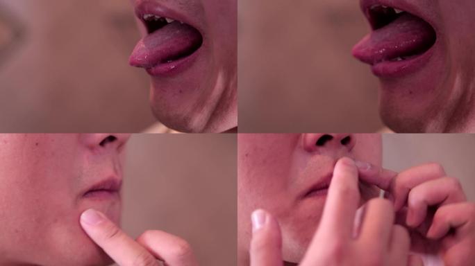 舌头舌苔脸皮肤青春痘痤疮长痘