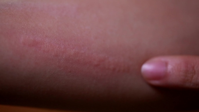 过敏荨麻疹皮肤体质挠痒季节
