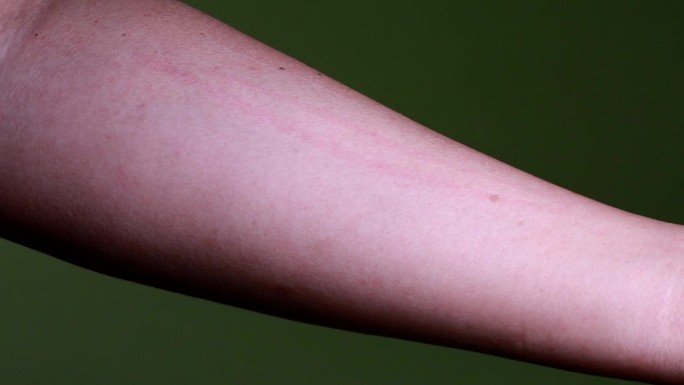 过敏荨麻疹皮肤体质挠痒季节