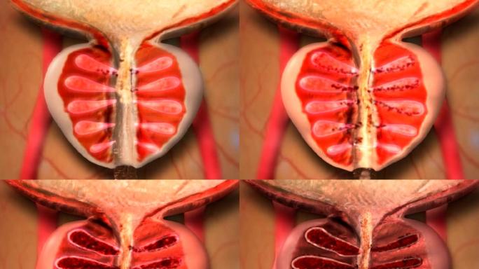 前列腺增生肥大