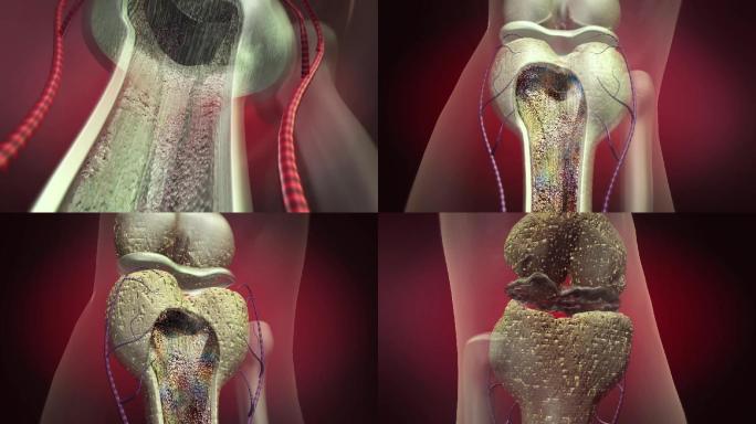 骨骼腔病变关节变形