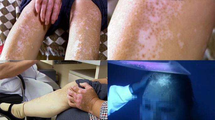 白癜风患者女病例