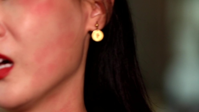 过敏荨麻疹皮肤体质挠痒季节换
