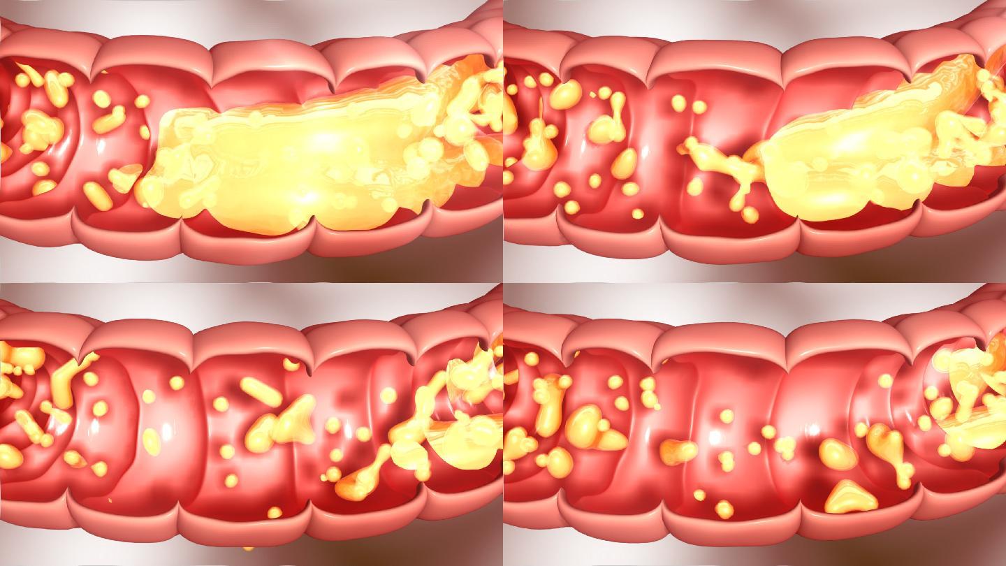 清除肠油刮肠油肠道肠道疾病益
