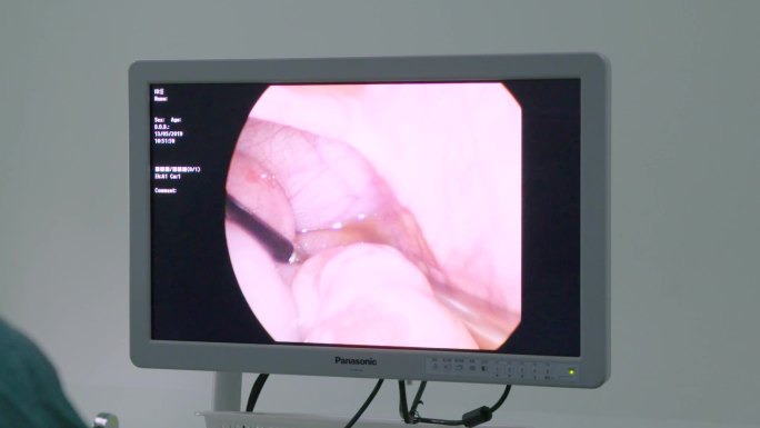 内窥镜手术腹腔镜手术微创手术