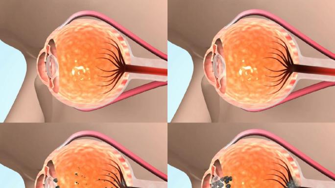 三维机理人体血管堵塞眼睛变坏