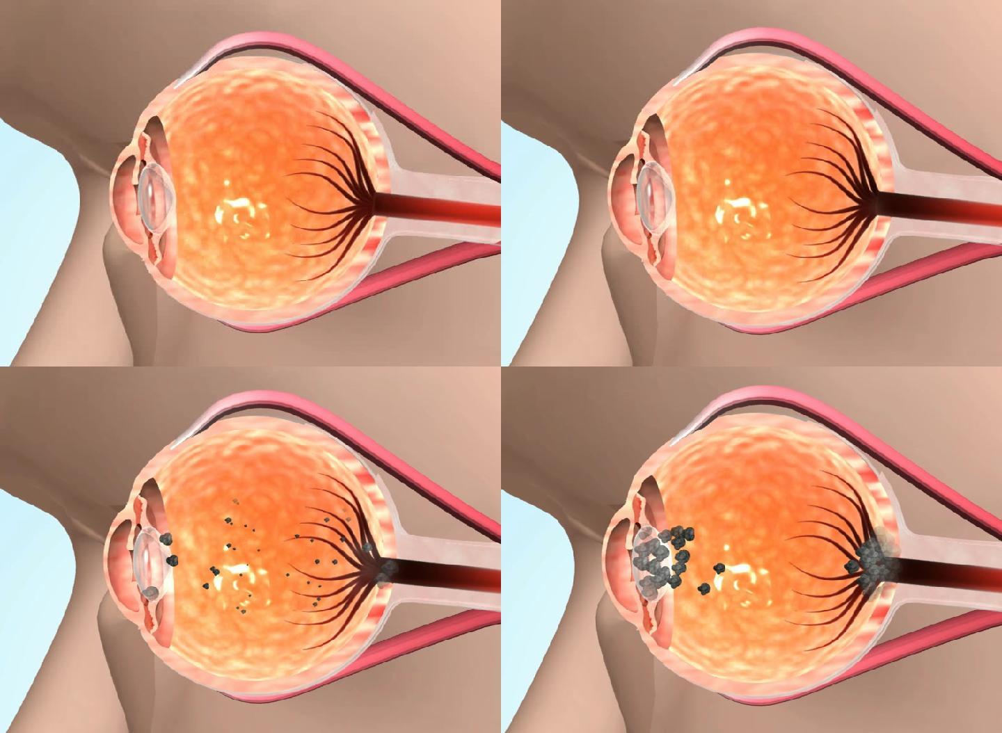 三维机理人体血管堵塞眼睛变坏
