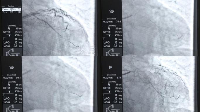 心脏起搏器植入手术显示屏