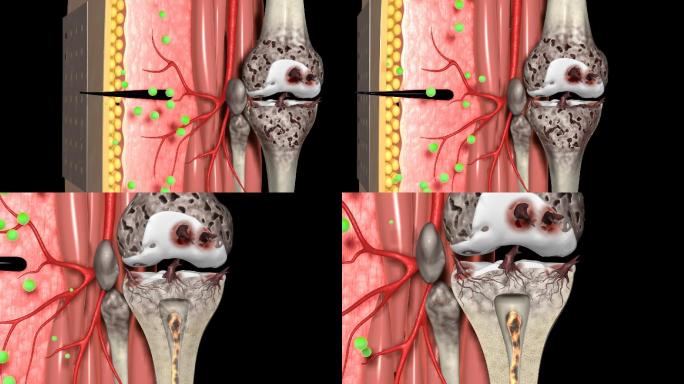 （带通道）膝盖风湿骨病
