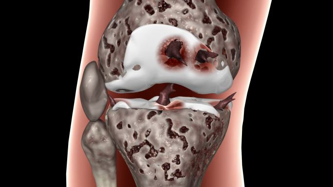 （带通道）膝盖关节炎
