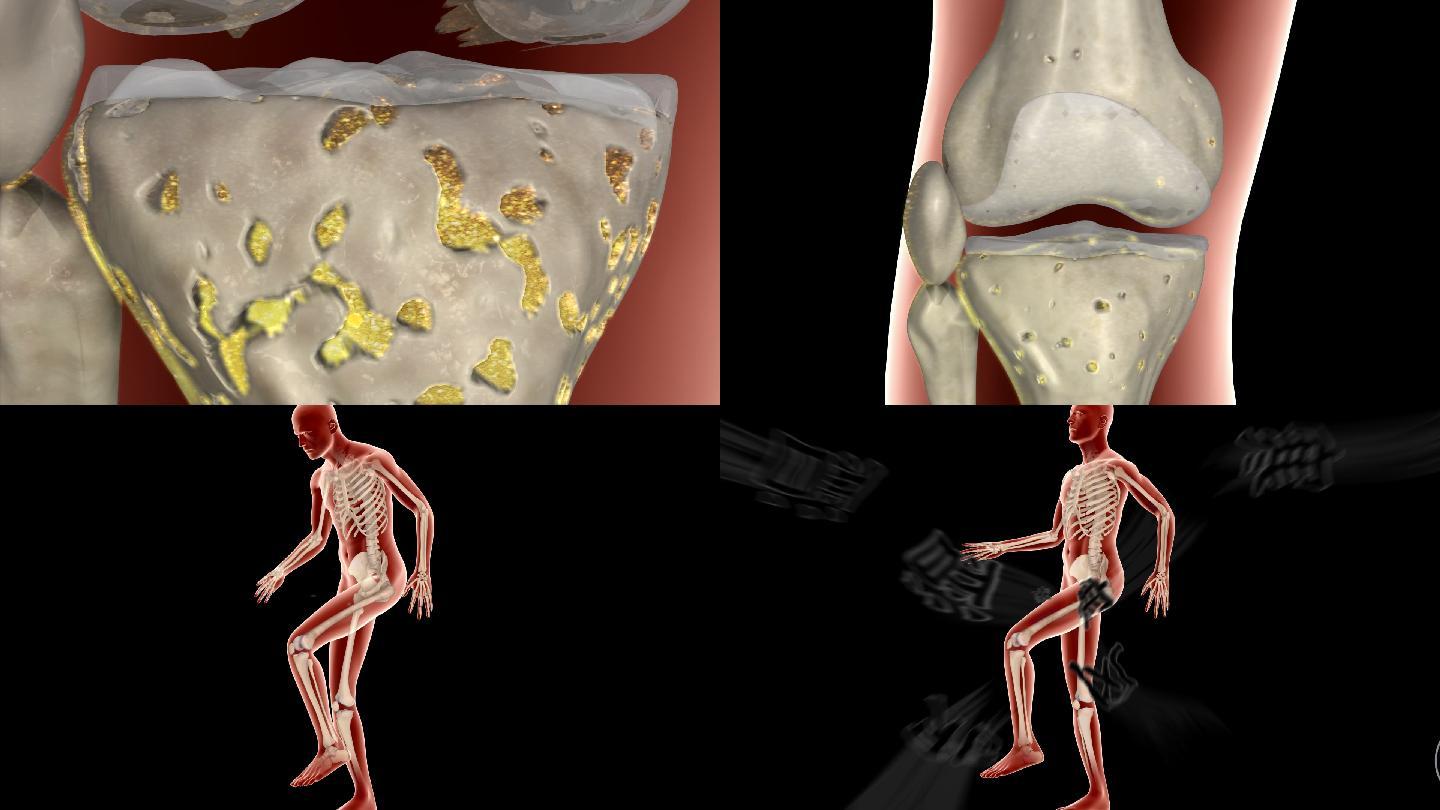 （带通道）膝盖关节炎