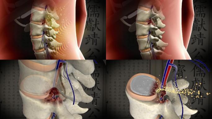 （带通道）腰椎键盘突出