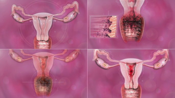 女性生殖系统内壁皱折淤积病变过程