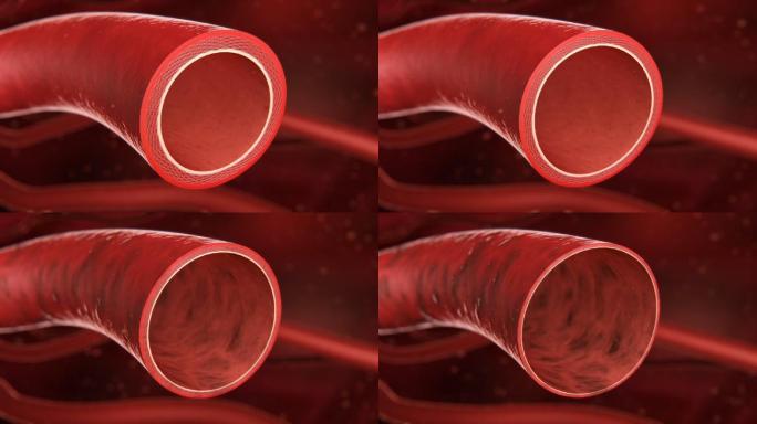 血管壁切面_变薄_老化