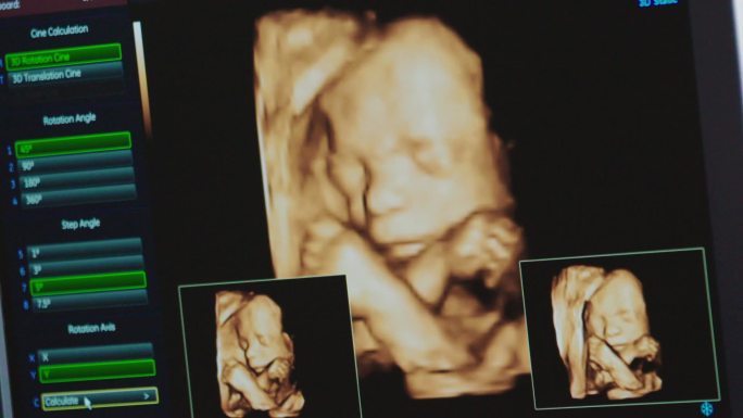 婴幼儿彩超胎儿孕检