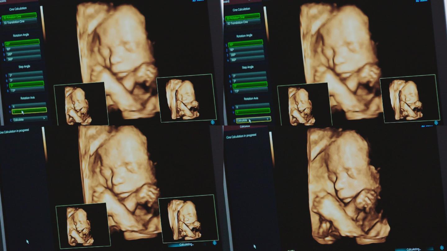 婴幼儿彩超胎儿孕检
