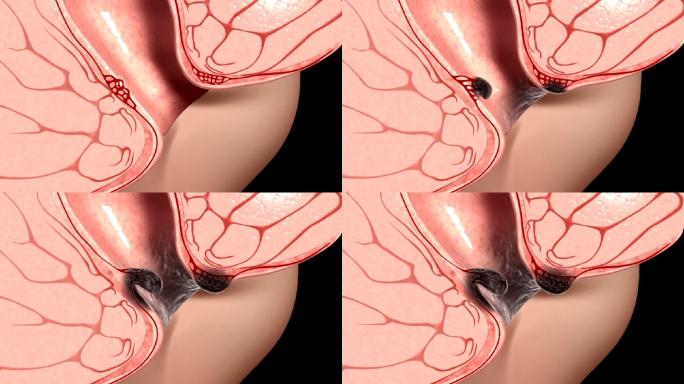 （带通道）痔疮