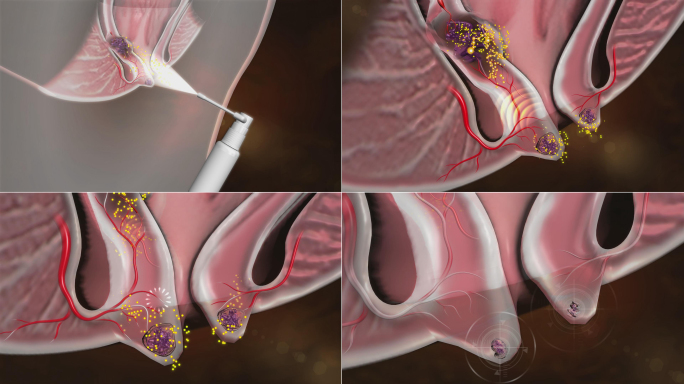 药物透皮渗入切断营养供应痔核逐个萎缩脱落