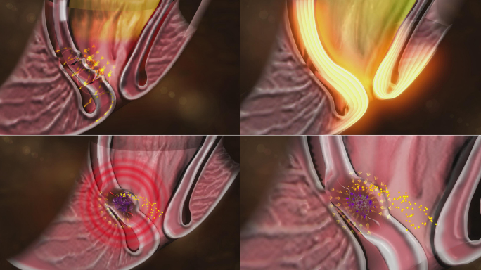 修复肛粘膜切断痔核营养通道使痔核干瘪蒌缩