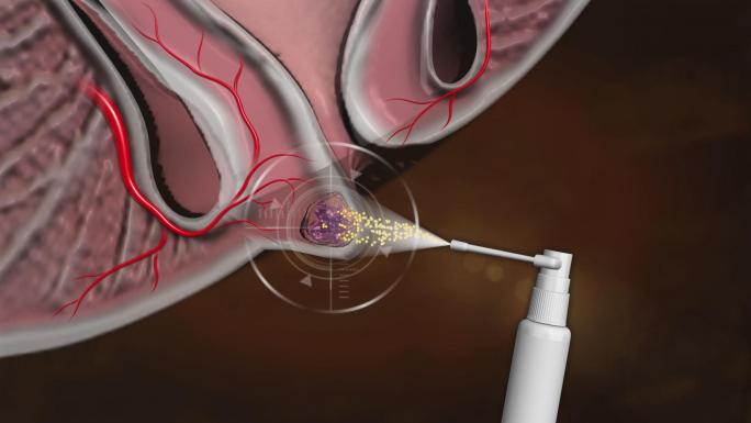 外痔、内痔、混合痔药物喷喷就好不复发