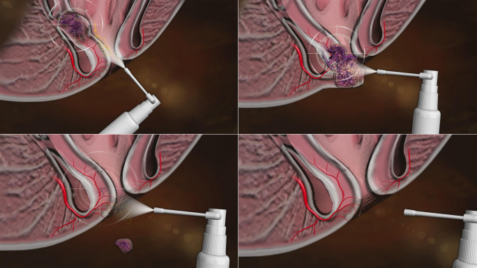 外痔、内痔、混合痔药物喷喷就好不复发