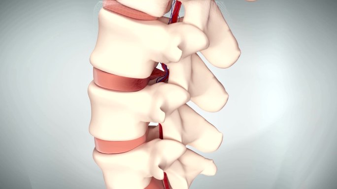 腰椎髓核溢出压迫神经