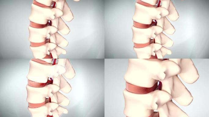 腰椎髓核溢出压迫神经