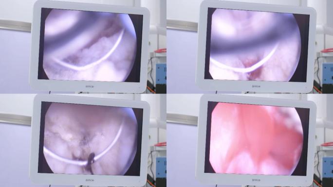4K医院医生做前列腺电切手术视频素材