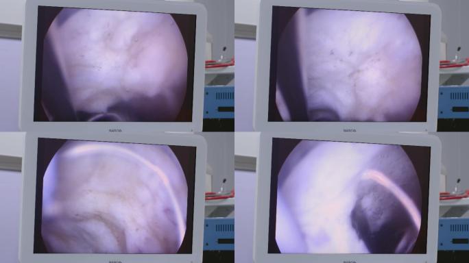 4K医院医生做前列腺电切内窥手术视频素材
