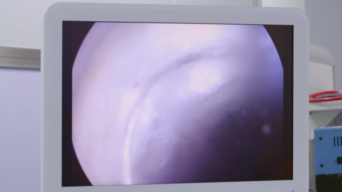 4K医院医生做前列腺电切内窥手术视频素材