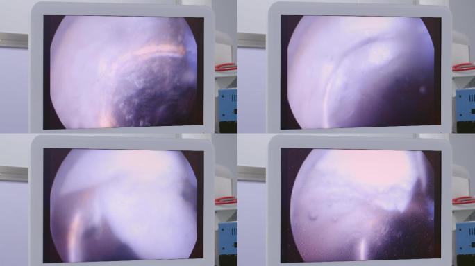 4K医院医生做前列腺电切内窥手术视频素材