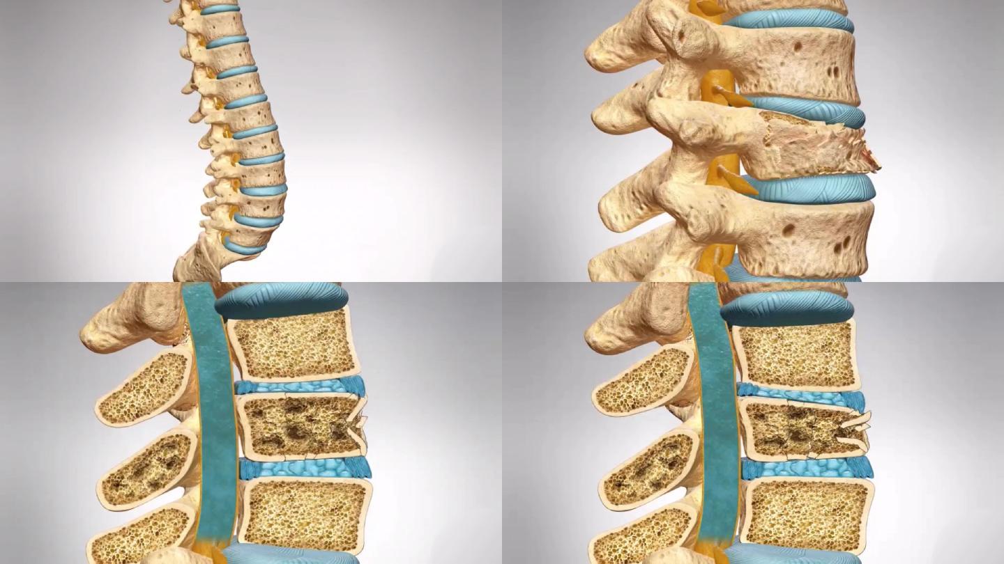 腰椎压缩三分之一图片,腰椎三分之一骨折图像,腰椎骨折正确睡姿图片_大山谷图库