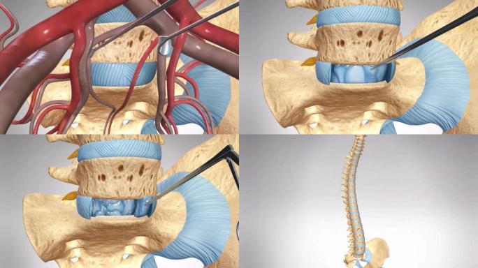 腰椎间盘突出腰椎间盘置换手术