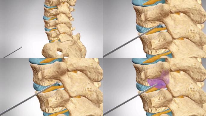 腰椎间孔注射治疗注药治疗