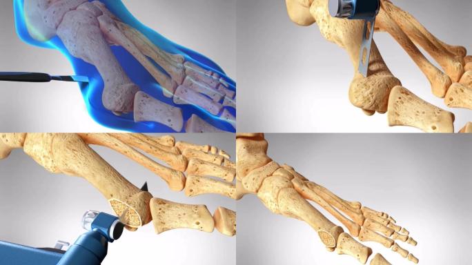 足拇囊炎切除手术三维演示动画