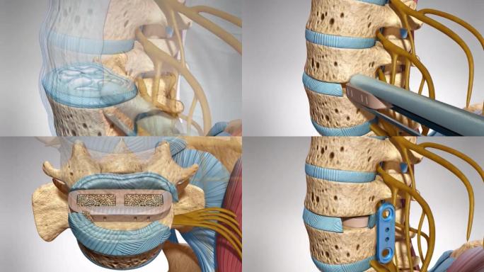 腰椎减压腰椎侧方融合术（LLIF）