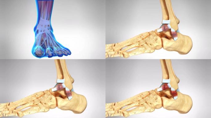 踝关节扭伤三维动画演示B