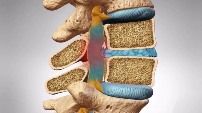 腰椎间盘突出腰椎病腰疼神经压迫