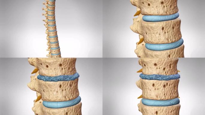 腰椎间盘压迫变形腰椎间盘突出