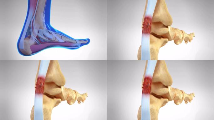 足跟腱鞘炎病理演示动画