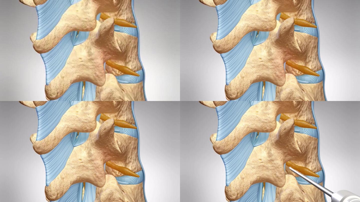 腰椎病腰椎疾病注射治疗缓解病痛