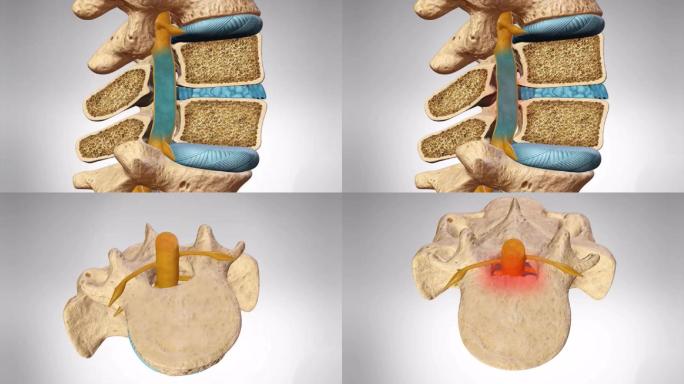 骨性压迫颈椎间盘突出腰椎间盘突出神经压迫