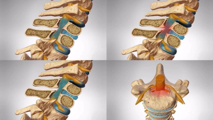 骨性压迫颈椎间盘突出腰椎间盘突出神经压迫