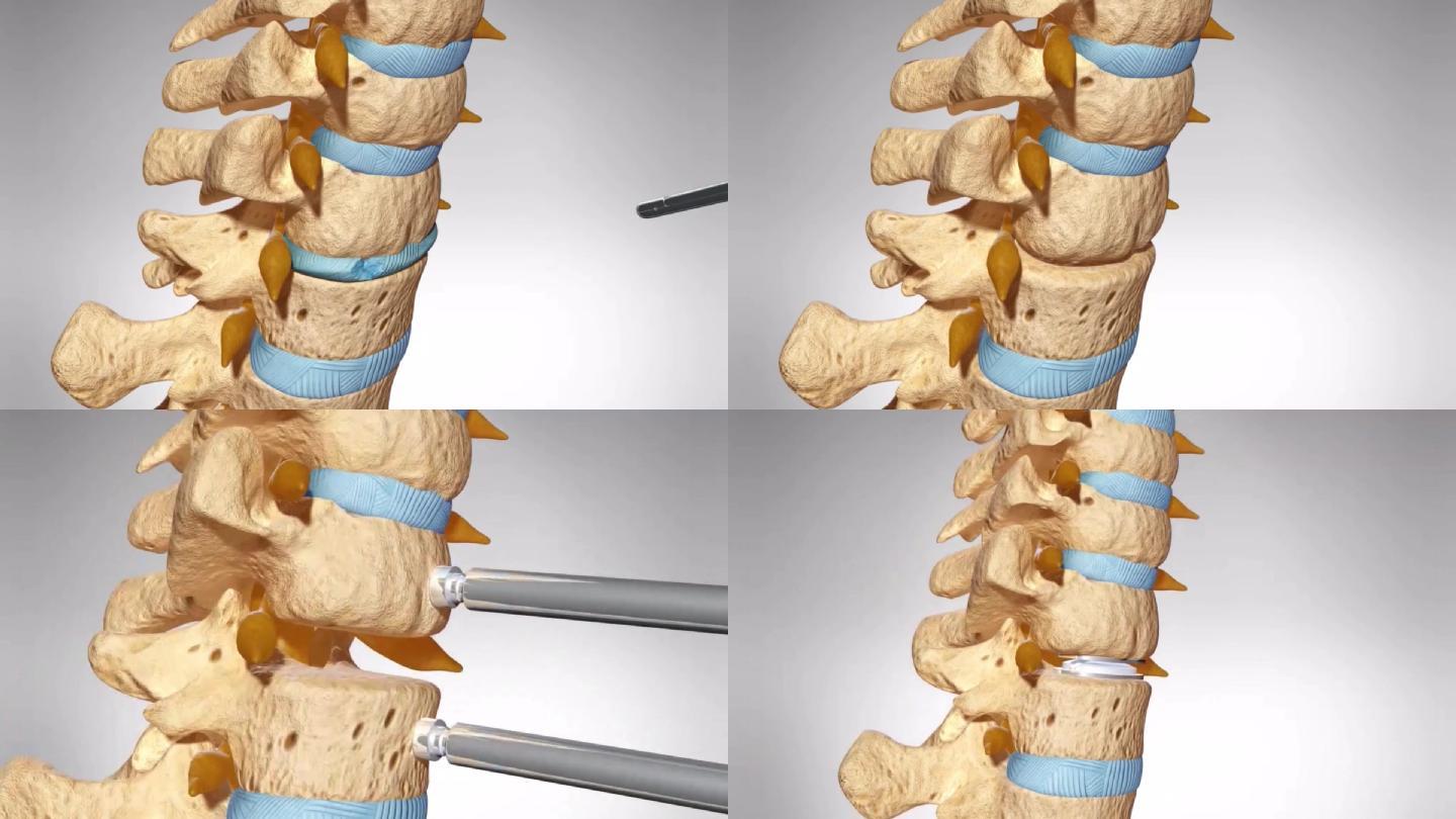 颈椎间融合手术颈椎间盘置换手术