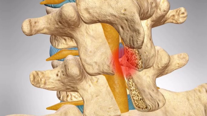 腰椎间盘突出腰椎病腰疼神经压迫