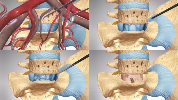 腰椎间融合手术腰椎间盘置换手术