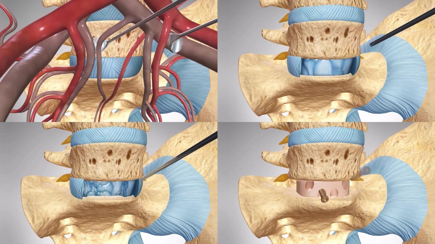 病例：三例椎间孔镜手术治愈腰5-骶1腰间盘突出症病例