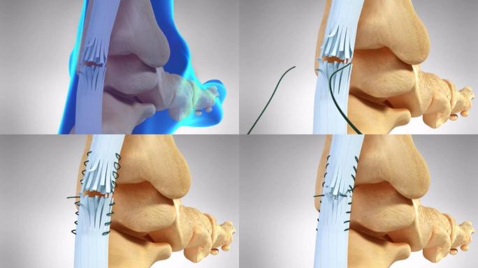 跟腱修复手术跟腱缝合手术