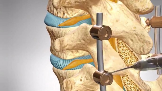 腰椎融合术腰椎融合手术演示动画