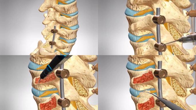 腰椎融合术腰椎融合手术演示动画